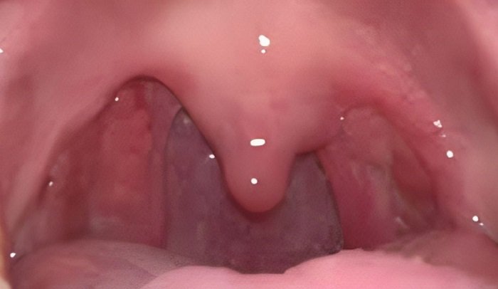 The Mystery of Tonsil Regrowth: Separating Fact from Fiction
